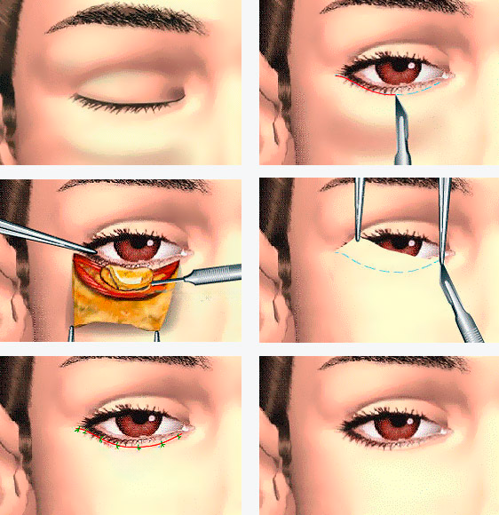 Blefaroplastia Inferior